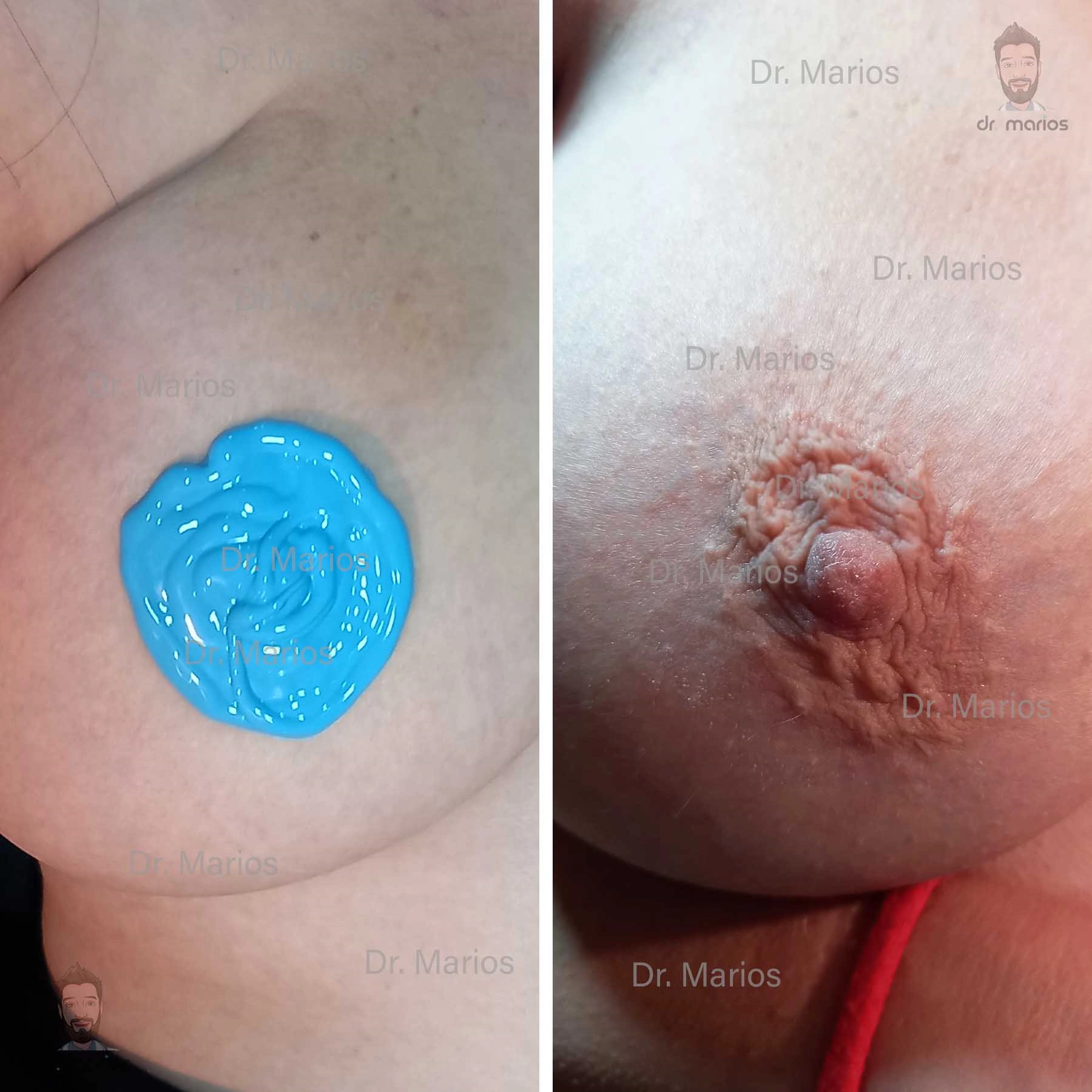 NippleArtboard 1
